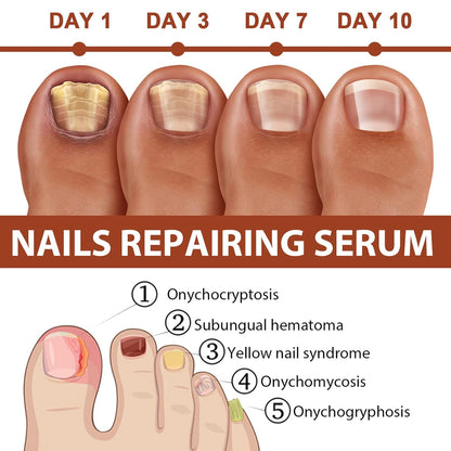 Rednow Gfouk 7 Days Nail – Suero Reparador y Fortalecedor de Uñas (2 Unidades) 🌸 Crecimiento y Cuidado en 7 Días